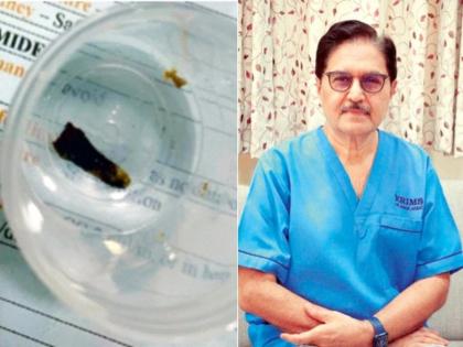 Seven years ago the cloves stuck in the lungs were removed; Doctors Team of Nagpur got success | सात वर्षांपूर्वी फुप्फुसात अडकलेली लवंग काढली बाहेर; नागपूरच्या चमूला मिळाले यश