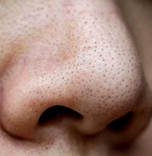 नाकावरचे ब्लॅकहेड्स, व्हाईटहेड्स ५ मिनिटांत हाेतील गायब, लगेच करा १ सोपा घरगुती उपाय