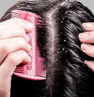 कापराच्या ४ वड्या - अर्धा लिंबू घेऊन ‘असा’ करा उपाय - डोक्यातला कोंडा एका धुण्यात जाईल पळून...