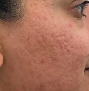 बिनपैशांचा घरगुती उपाय-‘या’ पांढऱ्या फुलांची जादू-चेहऱ्यावरचे ओपन पाेर्स करते गायब...