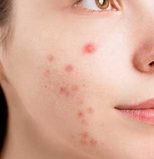 चेहऱ्यावर पिंपल्सचं जंगल, कसंतरी वाटतं? फक्त ५ गोष्टी करा, चेहऱ्यावरचे सगळे पिंपल्स होतील गायब