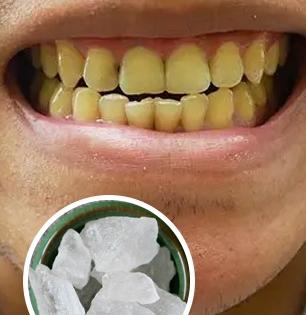 फक्त १० रुपये खर्च करा, पिवळसर दात पांढरेशुभ्र होऊन चमकतील-दातांची काळजी घ्या