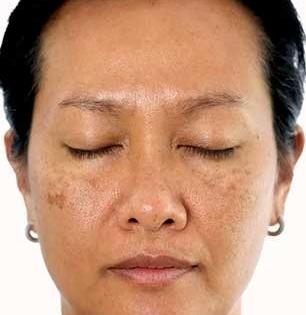 काळे डाग, पिगमेंटेशन होईल कायमचे गायब! किचनमधील फक्त एकच पदार्थ असरदार - त्वचा होईल बेबी सॉफ्ट...