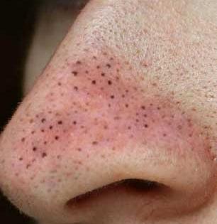 १ रुपयाही खर्च न करता काढा नाकावरचे ब्लॅकहेड्स मिनिटभरात! ५ मॅजिकल उपाय - त्वचा होईल आरशासारखी नितळ...