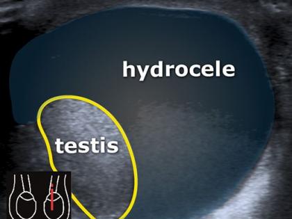 Hydrocele Patient negligence: Directives for Disciplinary Action on Inaction | हायड्रोसीलच्या रुग्णांची हेळसांड : अकार्यक्षमतेबाबत शिस्तभंगाची कारवाई करण्याचे निर्देश