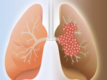 23 patients with post covid 'fibrosis'! | पोस्ट कोविडच्या २३ रुग्णांना ‘फायब्रोसिस’!