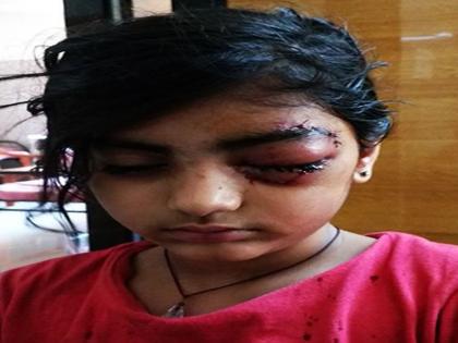 Injured child's eye in dog attac | जळगाव येथे भटक्या कुत्र्याच्या हल्ल्यात बालिकेच्या डोळ््याला गंभीर इजा, शस्त्रक्रियेदरम्यान पडले ५० टाके