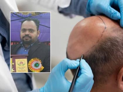 Engineer Vineet Dubey died after undergoing a hair transplant in Kanpur, due to infection, case registered against doctor | हेअर ट्रान्सप्लांट करणं इंजिनिअरच्या जीवावर बेतलं; इंफेक्शनमुळे मृत्यू, डॉक्टरवर गुन्हा दाखल Engineer Vineet Dubey died after undergoing a hair transplant in Kanpur, due to infection, case registered against doctor | हेअर ट्रान्सप्लांट करणं इंजिनिअरच्या जीवावर बेतलं; इंफेक्शनमुळे मृत्यू, डॉक्टरवर गुन्हा दाखल