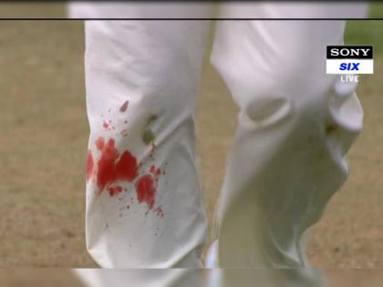 India vs England 4th test live : Blood from James Anderson's pant, but he's still bowling on, break sachin tendulkar record | India vs England 4th test Live : सचिन तेंडुलकरचा रेकॉर्ड मोडणाऱ्या जेम्स अँडरसनचं 'समर्पण' पाहा; Photo Viral 