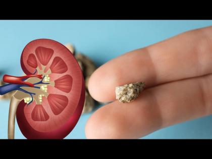 How to dissolve kidney stones dr told easy home remedy | 7 दिवसात या उपायाने बाहेर निघेल किडनी स्टोन, डॉक्टरांनी सांगितली खास पद्धत!