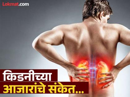 Signs you may have kidney disease, you should know | पाय आणि डोळ्यांवर सूज किडनीची समस्या असल्यावर शरीरात दिसतात 'हे' संकेत, दुर्लक्ष कराल तर...