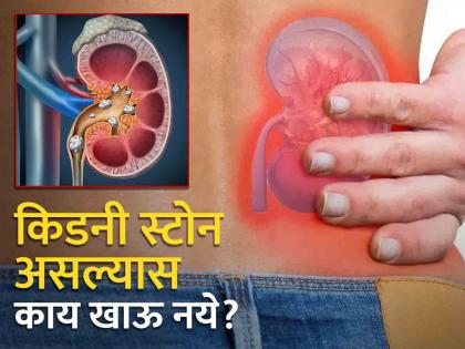 Kidney stone patient should avoid eating these 3 things the problem may increase | किडनी स्टोनच्या रूग्णांनी चुकूनही खाऊ नये 'या' ३ गोष्टी, अधिक वाढू शकते समस्या!