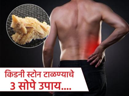 Doctor shares 3 dietary tips for kidney stones | डॉक्टरांनी सांगितले किडनी स्टोनपासून बचावाचे 3 सोपे उपाय, असह्य वेदना होतील दूर... Doctor shares 3 dietary tips for kidney stones | डॉक्टरांनी सांगितले किडनी स्टोनपासून बचावाचे 3 सोपे उपाय, असह्य वेदना होतील दूर...