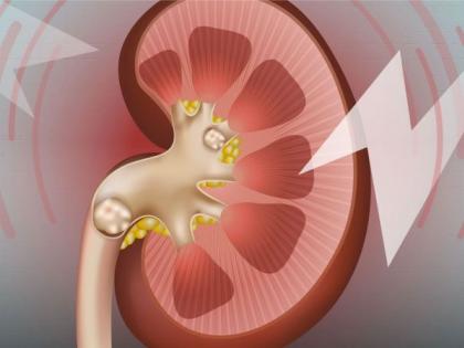 Risk of 'Kidney Stone' due to increase in screen time! | स्क्रीन टाइम वाढल्याने ‘किडनी स्टोन’चा धोका!