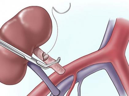 Kidney transplant is now possible in Akola too! | आता अकोल्यातही किडनी प्रत्यारोपण शक्य!