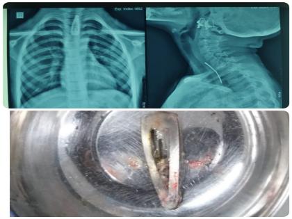 Hairpin stuck in esophagus, seven year old girl saved after successful surgery in cpr hospital kolhapur | अन्ननलिकेत अडकली केसांत घालायची पिन, यशस्वी शस्त्रक्रियेनंतर सात वर्षाच्या बालिकेला मिळाले जीवदान