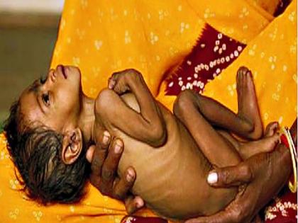 35 children in the district are out of malnutrition improvement in seven children | जिल्ह्यातील ३५ बालके कुपोषणातून बाहेर, सात बालकांत सुधारणा