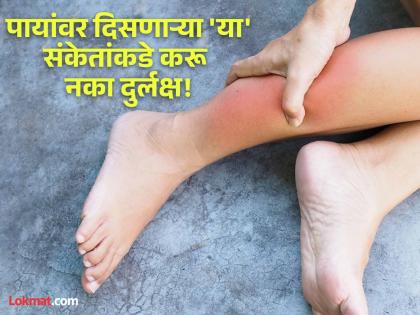 Doctor tells about diseases signs on feet how to identify disease by feet | डॉक्टरांनी सांगितले पायांवर दिसतात वेगवेगळ्या आजारांचे 'हे' संकेत, वेळीच व्हा सावध!