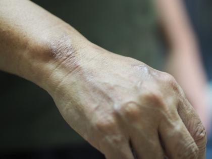 13 new patients found in Latur district in leprosy eradication survey | कुष्ठरोगमुक्ती सर्वेक्षणात लातूर जिल्ह्यात आढळले नवीन १३ रुग्ण 13 new patients found in Latur district in leprosy eradication survey | कुष्ठरोगमुक्ती सर्वेक्षणात लातूर जिल्ह्यात आढळले नवीन १३ रुग्ण