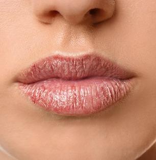 उन्हाळ्यात ओठ का फुटतात? साल निघतं, रक्त येतं अशा कोरड्या ओठांसाठी पाहा घरगुती उपाय