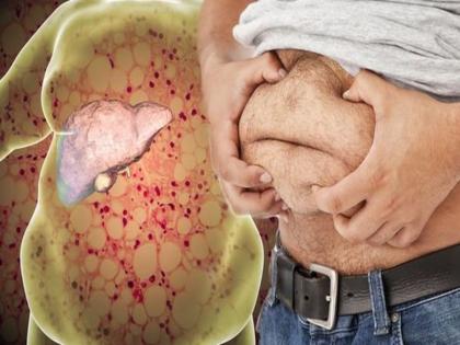 Liver failure : warning signs, symptoms, causes types of Liver failure | Liver failure : हे ५ संकेत सांगतात की योग्यप्रकारे काम करत नाही तुमचं लिव्हर, दुर्लक्ष करणं पडेल महागात