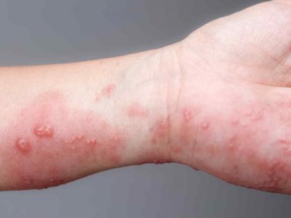 Beware! This is not an allergy: 'Blistering Disease' starts simple but has serious consequences | सावधान! ही ॲलर्जी नाही : 'ब्लिस्टरिंग डिसीज'ची सुरुवात साधी पण परिणाम गंभीर Beware! This is not an allergy: 'Blistering Disease' starts simple but has serious consequences | सावधान! ही ॲलर्जी नाही : 'ब्लिस्टरिंग डिसीज'ची सुरुवात साधी पण परिणाम गंभीर