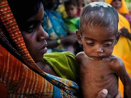 Schemes upon schemes , but hungry stomachs; The heartbreaking reality of 310 malnourished children in Gondia! | योजनांवर योजना, पण पोट मात्र भुकेले; गोंदियात ३१० कुपोषित बालकांचे विदारक वास्तव ! Schemes upon schemes , but hungry stomachs; The heartbreaking reality of 310 malnourished children in Gondia! | योजनांवर योजना, पण पोट मात्र भुकेले; गोंदियात ३१० कुपोषित बालकांचे विदारक वास्तव !