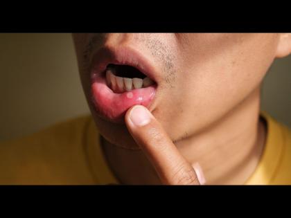 Mouth infection white blisters symptoms of serious disease in bod | तोंडात होणाऱ्या फोडांकडे करू नका दुर्लक्ष, जाणून घ्या याची कारणं!