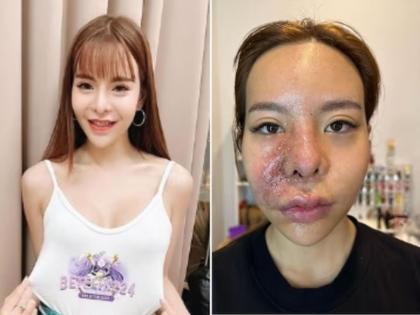 thailand model used cheap filler on face gets blisters pus due to reaction | पैसे वाचवण्यासाठी मॉडेलची स्वस्तात सर्जरी; झाली भयंकर अवस्था, आली चेहरा लपवण्याची वेळ