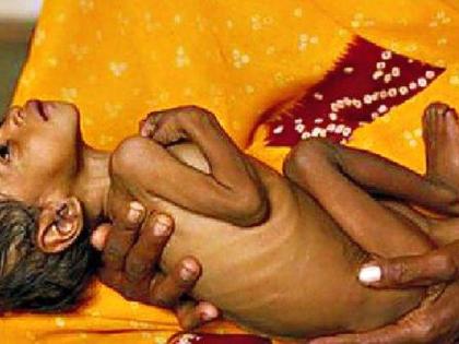 300 severely malnourished children found in Gondia district | धक्कादायक...! गाेंदिया जिल्ह्यात आढळली अतितीव्र कुपोषित ३०० बालके