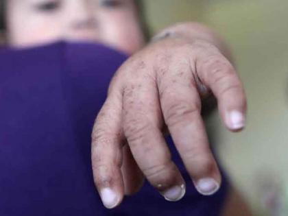 Global measles outbreaks make 2019 a record-setting year | २०१८ च्या तुलनेत २०१९ मध्ये 'या' गंभीर आजाराच्या केसेसमध्ये ३ पटीने वाढ!