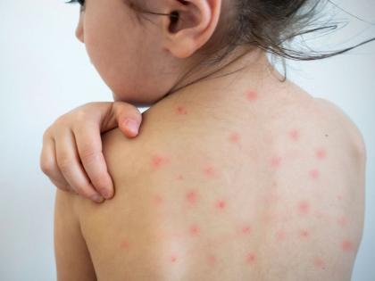 12 more measles patients in Mumbai | मुंबईत गोवराचे आणखी १२ रुग्ण