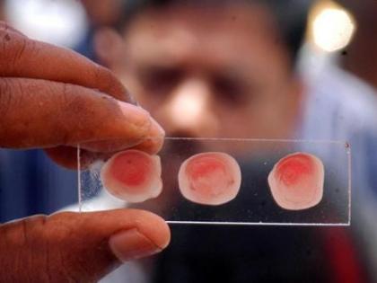 Two rare blood group 'Parabombe O Positive' found for the first time in Nagpur | नागपुरात पहिल्यांदाच आढळल्या 'पॅराबॉम्बे ओ पॉझिटिव्ह' या दुर्मिळ रक्तगटाच्या दोन व्यक्ती