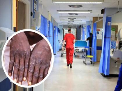 Anxiety increased! First death due to monkeypox in India, young man returning from UAE | Monkeypox: चिंता वाढली! मंकीपॉक्समुळे भारतात पहिला मृत्यू, यूएईमधून परतला होता तरुण 