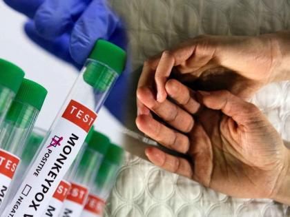 लैंगिक संबंधातून मंकीपॉक्स संक्रमित होण्याचा धोका?; रिपोर्टमधून मोठा खुलासा