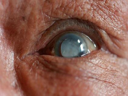 मोतीबिंदूनंतरही आता नैसर्गिक दृष्टी;  स्वप्नवत गोष्ट प्रत्यक्षात... - Marathi News | Natural vision now even after cataracts; A dream come true... | Latest health News at Lokmat.com