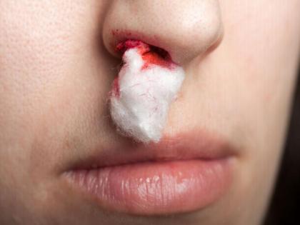 What to do if the nose bleeds? | उन्हाळा सुरू होतोय, नाकातून रक्त आले तर काय कराल? What to do if the nose bleeds? | उन्हाळा सुरू होतोय, नाकातून रक्त आले तर काय कराल?