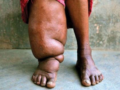 Four thousand patients of elephantiasis in Nagpur district | नागपूर जिल्ह्यात हत्तीपायाचे चार हजारांवर रुग्ण