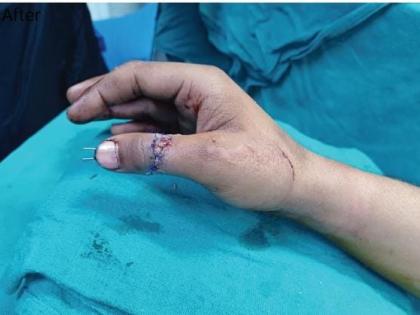 The thumb got caught in the chain of the bike and broke | बाईकच्या चेनमध्ये हाताचा अंगठा अडकून तुटला