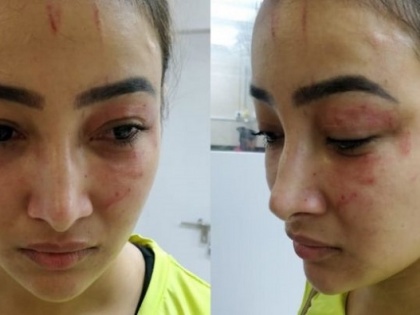 splitsvilla and naamkarann fame nalini negi accuses her roommate preeti rana of physical assault | या अभिनेत्रीवर रूममेटने केला जीवघेणा हल्ला, चेहरा विद्रूप करण्याचाही प्रयत्न 