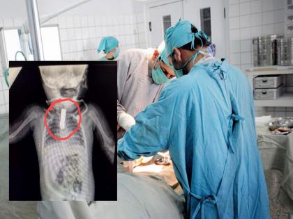 Shocking event! An eight-month-old baby swallowed a nail cutter while playing; The doctor performed surgery and saved his life | धक्कादायक घटना! आठ महिन्यांच्या बाळाने खेळताना गिळले नेलकटर; डॉक्टरांनी शस्त्रक्रिया करून वाचवला जीव