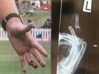 Jimmy Neesham shares pictures of horror finger injury so bad Instagram hid them before undergoing surgery | OMG : न्यूझीलंडच्या स्टार खेळाडूचं बोट मोडलं; शेअर केला खतरनाक फोटो!