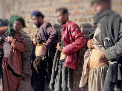 Desperate Afghans resort to selling their kidneys to feed families | मुलांचे पोट भरण्यासाठी वडील विकतात स्वत:ची किडनी; अफगाणिस्तानात दुर्दैवाचे दशावतार