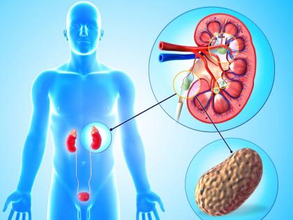 Kidney Stone Surgery With New Ultrasonic Techniques | ध्वनिलहरींच्या नव्या तंत्राने कमी खर्चात हाेऊ शकणार किडनी स्टोनची शस्त्रक्रिया