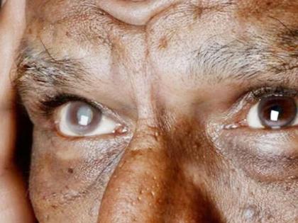 6 patients lose sight after cataract surgery CMo orders probe Incidents in Kanpur | मोतीबिंदूच्या ऑपरेशननंतर ६ रुग्णांची दृष्टीच गेली, मुख्यमंत्री कार्यालयाकडून चौकशीचे आदेश; कानपूरमधील घटना