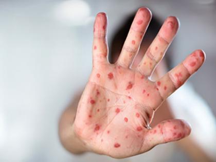 75 percent of measles patients have not been vaccinated | गोवर बाधीत ७५ टक्के रुग्णांचे लसीकरण झालेच नाही