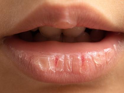 Health Tips: उन्हाळ्यातही तुमचे ओठ फुटतात? जाणून घ्या कारण आणि झटपट उपाय!