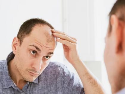 Is there a direct link between baldness and getting rich? Let's find out! | टक्कल पडण्याचा आणि श्रीमंत होण्याचा दुरान्वये संबंध आहे का? चला जाणून घेऊ!