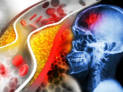 Study says low levels of cholesterol cause risk of stroke | कोलेस्ट्रॉल कमी झाल्यास हॅमरेजिक स्ट्रोकचा धोका, जाणून घ्या कसं ठेवाल नियंत्रणात?