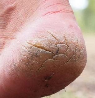 टाचांना भेगा पडल्या, रक्त निघतंय? रात्री झोपण्यापूर्वी टाचांना लावा 'हा' पांढरा पदार्थ, त्वचा होईल मुलायम